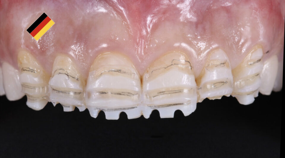 Veneers & Onlays bei Zahnhartsubstanzverlust