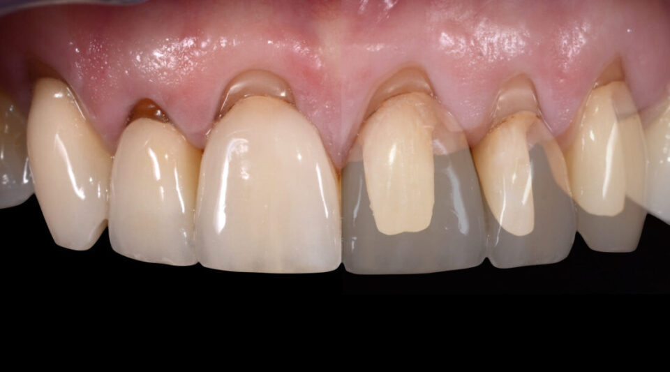 Soft Tissue Regeneration for Dental Restorations