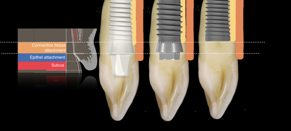 metal-free implant-supported single-tooth restorations