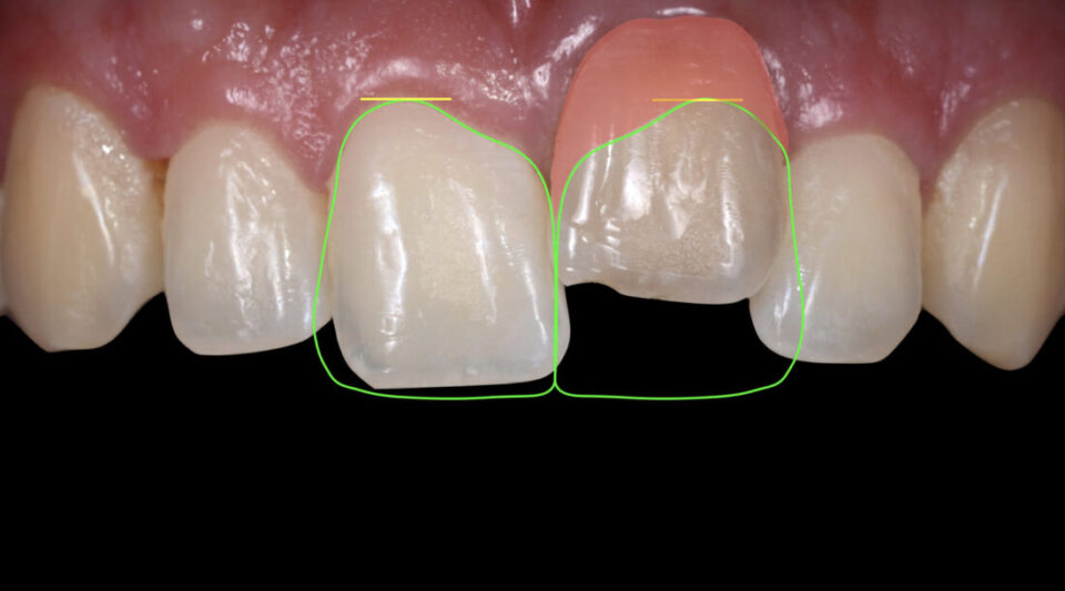 Ankylosed tooth - Minimally Invasive Treatment with a Ceramic Veneer