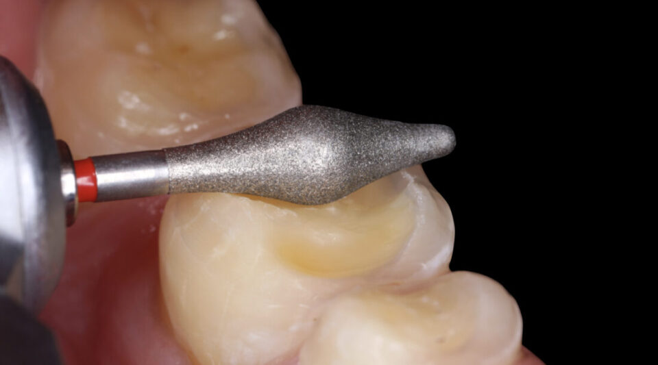 preparation of occlusal onlays