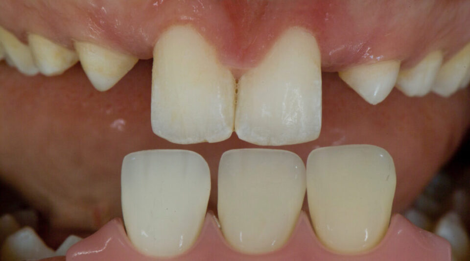 dental aplasia, Otto Prandtner, Rezotto Production