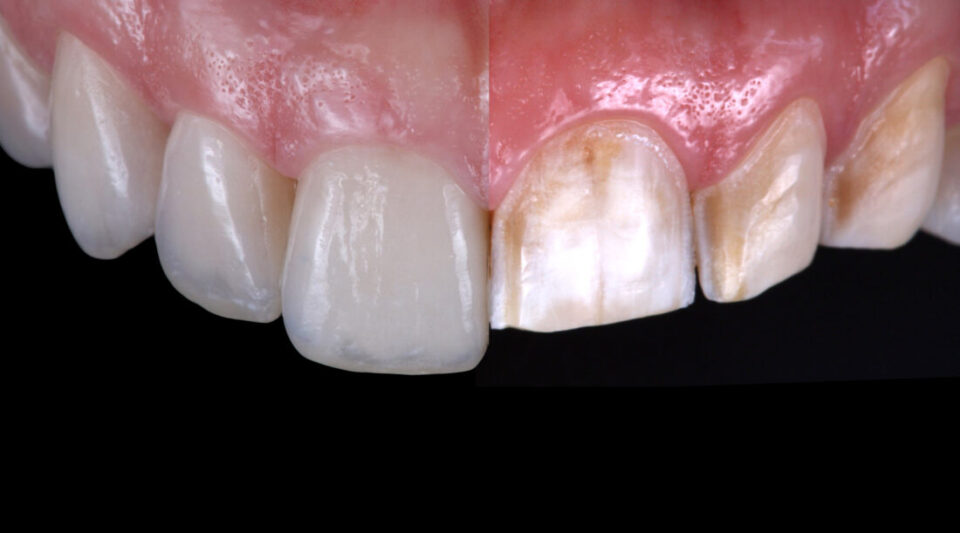 Porcelain veneers and CAD:CAM polymer restorations for amelogenesis imperfecta